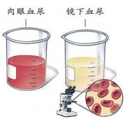 小便带血怎么回事?塔城博爱医院全解析